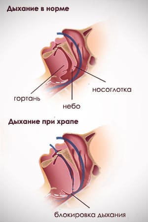 храп апноэ